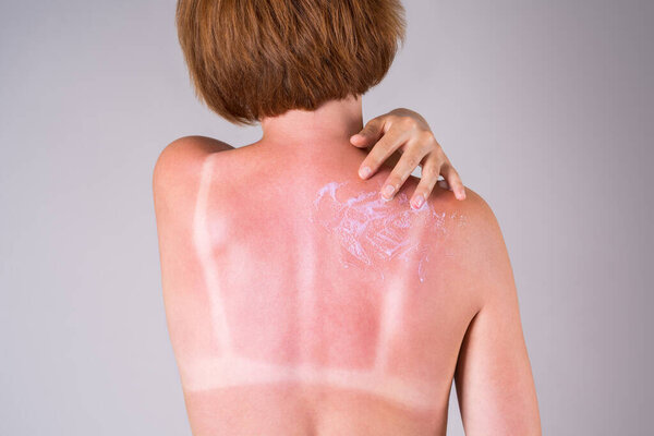 Загорелая женщина наносит солнцезащитный крем на спину, следы от солнечных ожогов на теле, студийный серый фон