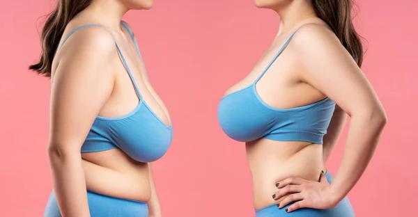 胸の拡張の概念の前と後に ピンクの背景に矯正手術後に非常に大きなシリコン胸を持つ女性 ロイヤリティフリーのストック画像