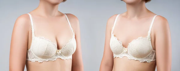 Före Och Efter Bröst Augmentation Koncept Kvinna Med Stora Silikonbröst — Stockfoto