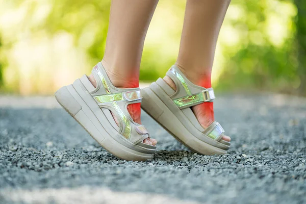 Bir Kadının Ayaklarına Sürtünen Rahatsız Ayakkabılar Bir Kadının Ayaklarında Nasırlar — Stok fotoğraf