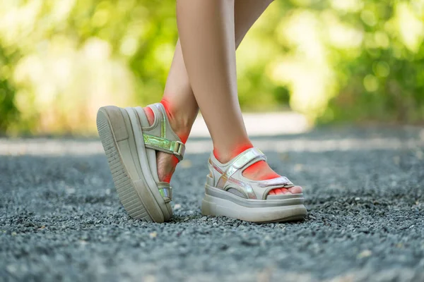 Bir Kadının Ayaklarına Sürtünen Rahatsız Ayakkabılar Bir Kadının Ayaklarında Nasırlar — Stok fotoğraf