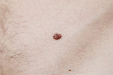 Birthmark on the human body close-up clipart
