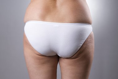 Fatty female ass with cellulite and stretch marks clipart