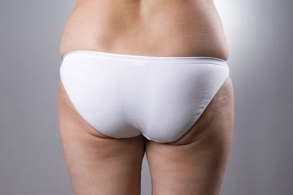 Fatty female ass with cellulite and stretch marks — Stock Photo, Image
