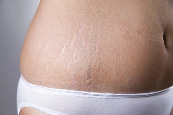 Barriga feminina com estrias closeup — Fotografia de Stock