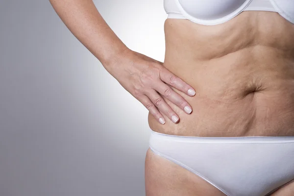 Flabby stomach of an elderly woman close-up — Stockfoto