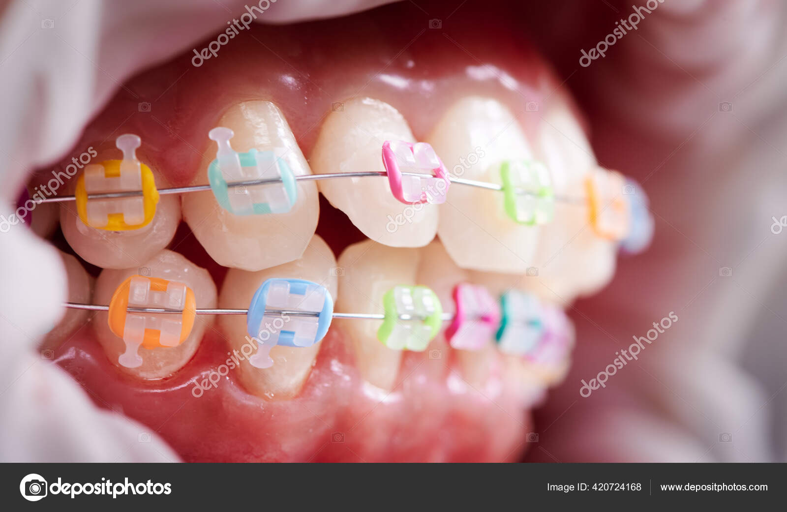 牙齿咬合牙齿和陶瓷牙套的宏观快照上有彩色橡皮筋唇上有乳胶面拉张口腔卫生概念——图库图片© anatoliy_gleb #420724168