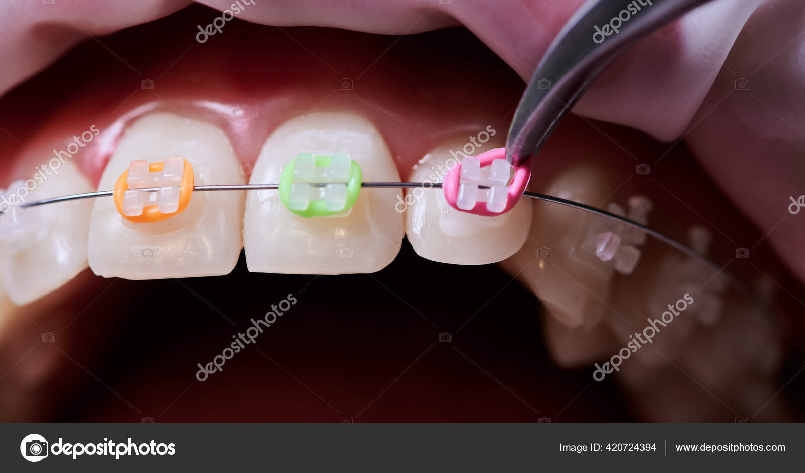 Macro Instantané Procédure Dentaire Processus Fixation Bandes Caoutchouc  Colorées Aux image libre de droit par anatoliy_gleb © #420724394