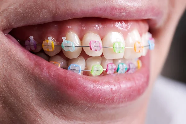 Close Orthodontic Braces Colorful Rings Teeth Woman Patient Demonstrating Dental — Stock Photo, Image