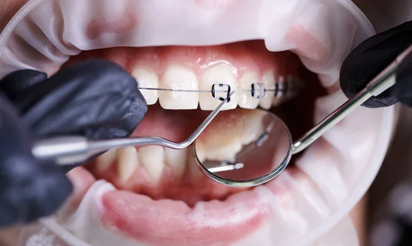 Close up view on dentist in black gloves taking off black rubber bands from ceramic braces with a help of dental hook to replace rusty wire which connects the braces. Concept of orthodontics treatment