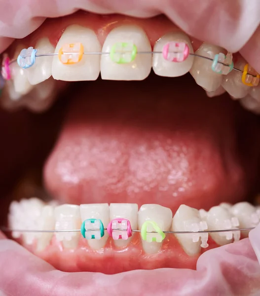 Makro Schnappschuss Von Geöffnetem Mund Zunge Zähnen Und Keramikspangen Mit — Stockfoto