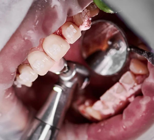 Close up view on cleaning teeth of patient with cheek retractor in