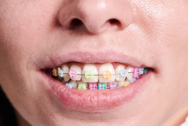Horizontal close-up snapshot of beautiful woman\'s smile, demonstrating white healthy teeth with ceramic braces, united with a wire and colorful rubber bands. Front view with a tip of nose