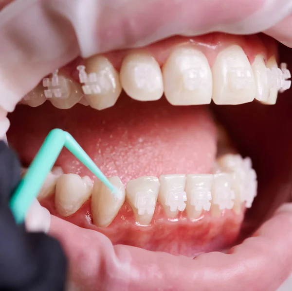 Makro Ujęcie Ręki Dentysty Mycie Dolnych Zębów Malutką Zieloną Szczotką — Zdjęcie stockowe