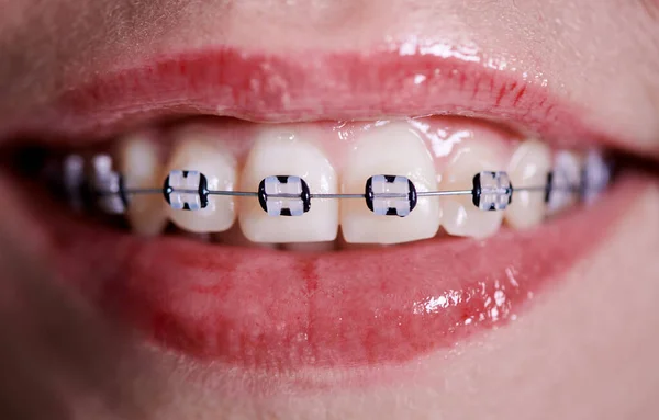 Horizontal Close Snapshot Beautiful Woman Smile Demonstrating White Healthy Teeth — Stock Photo, Image