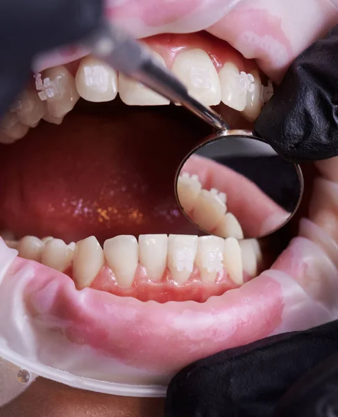 Zahnarzt Überprüft Die Unteren Zähne Des Patienten Mit Hilfe Eines — Stockfoto