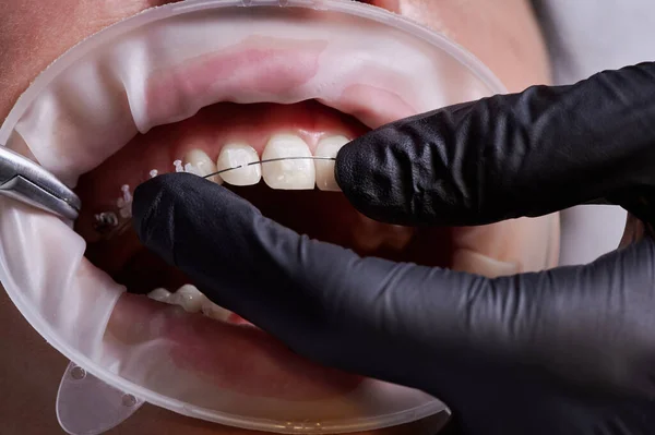 Close-up of dentist\'s hands in black gloves making dental procedure, process of attaching white ceramic braces and steel wire with a help of tongs. Latex cheek retractor on mouth. Concept of dentistry