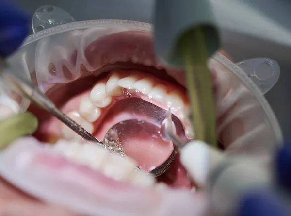 Nahaufnahme Eines Patienten Mit Wangenrückzieher Mund Der Zahnärztlich Behandelt Wird — Stockfoto