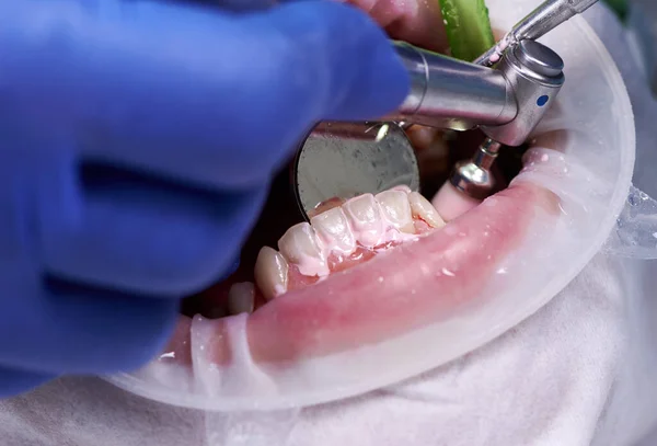Nahaufnahme Des Parodontologen Mit Zahnpolierer Und Spiegelreinigung Der Zähne Des — Stockfoto