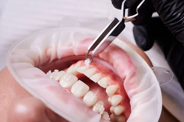 Nahaufnahme Eines Kieferorthopäden Der Frauen Zahnspangen Anlegt Patient Mit Wangenrückzieher — Stockfoto