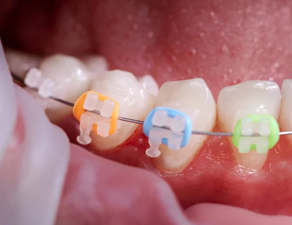 Close-up snapshot of a few lower teeth in mouth during procedure of installation ceramic braces, steel wire and colorful rubber bands. Process of replacing old braces into new ones