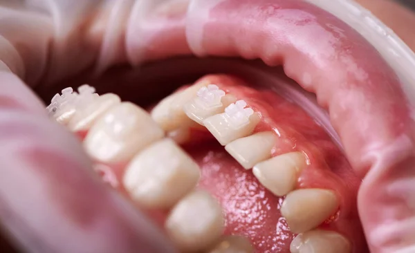 Zbliżenie Pacjenta Otwartymi Ustami Białymi Zębami Nawiasami Ortodontycznymi Młoda Osoba — Zdjęcie stockowe