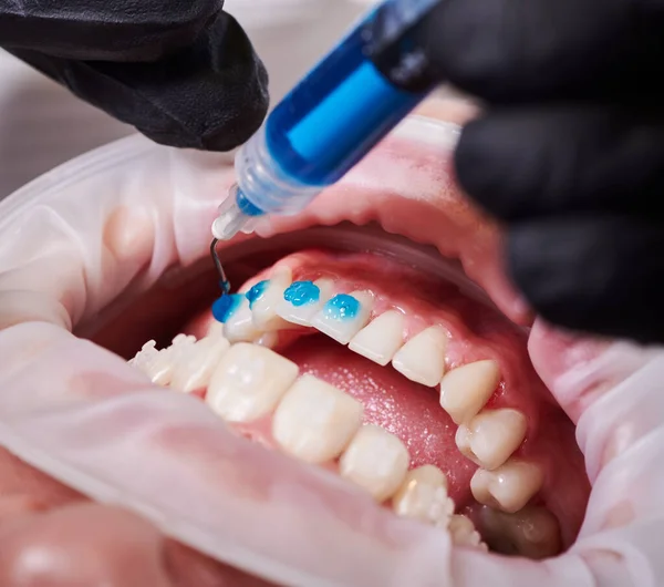 Ceramic braces installation process. Close-up top view on dentist\'s hands putting some blue glue on patient\'s clean lower teeth before attaching braces. Dental accessories concept