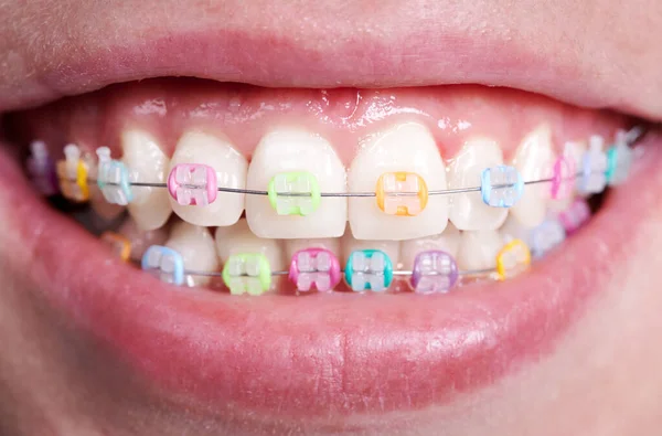 Horizontal Closeup Snapshot Beautiful Woman Smile Demonstrating White Healthy Teeth — Stock Photo, Image