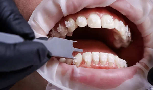 Menutup Ortodontis Menggunakan Alat Pengukur Aluminium Sambil Menempelkan Kawat Gigi — Stok Foto