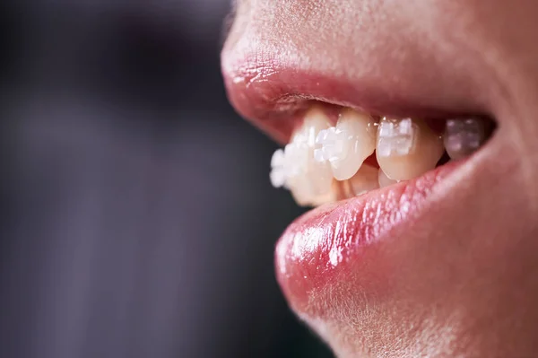 Close Smiling Woman Opened Mouth Demonstrating White Teeth Orthodontic Brackets — Stock Photo, Image