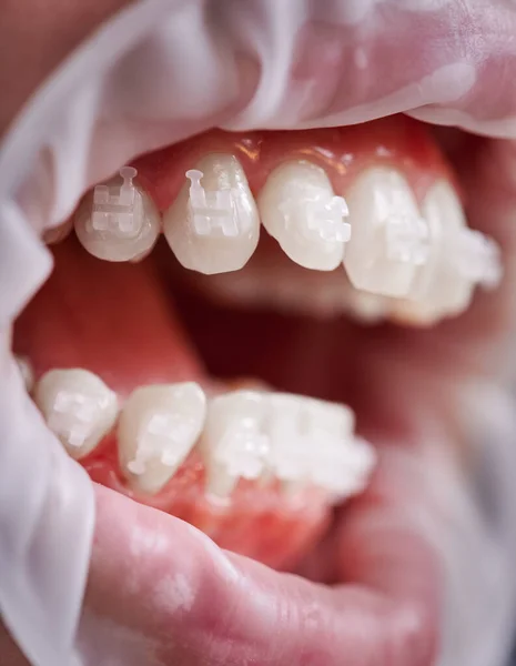 Zbliżenie Osoby Otwartymi Ustami Białymi Zębami Aparatem Ortodontycznym Pacjent Zwijaczem — Zdjęcie stockowe