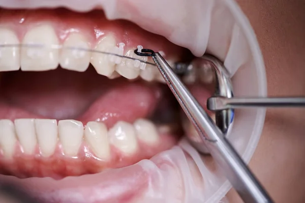 Close up view on dentist taking off black rubber bands from ceramic braces with a help of dental hook to replace rusty wire which connects the braces. Concept of orthodontics treatment and dentistry