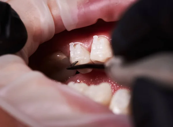 Nahaufnahme Eines Kieferorthopäden Der Den Zähnen Des Patienten Kieferorthopädische Klammern — Stockfoto