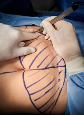 Ameliyathanede estetik ameliyat yaparken neşter kullanan beyaz steril eldivenli doktorların ellerini kapatın. Cerrah derisinde izler olan bir hastanın karnını kesiyor. Ameliyat ve abdominoplasti kavramı.