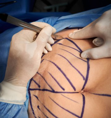 Cerrahların ellerine beyaz steril eldiven takıp hastanedeki ameliyathanede estetik ameliyat yaparken neşter kullanmalarını istiyorum. Estetik cerrahi ve abdominoplasti kavramı.