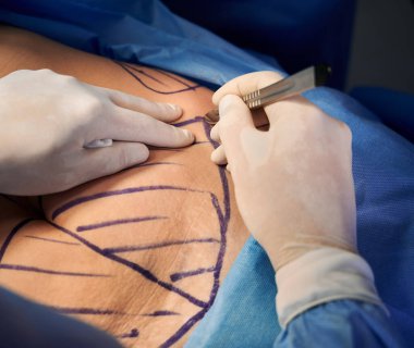 Ameliyathanede estetik ameliyat yaparken neşter kullanan steril eldivenli doktorların ellerini kapatın. Estetik cerrah kadın hasta karnını derisinde izlerle kesiyor. Abdominoplasti kavramı