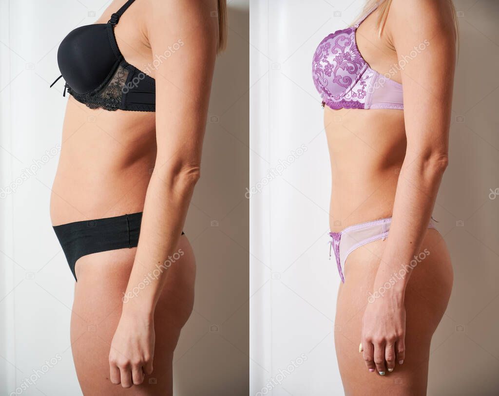 Side view of woman's body before and after weight loss, plastic surgery concept
