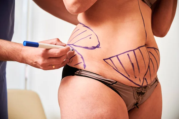 Detailní Záběr Doktorových Rukou Kreslících Stopy Pacientově Kůži Tlusté Ženy — Stock fotografie
