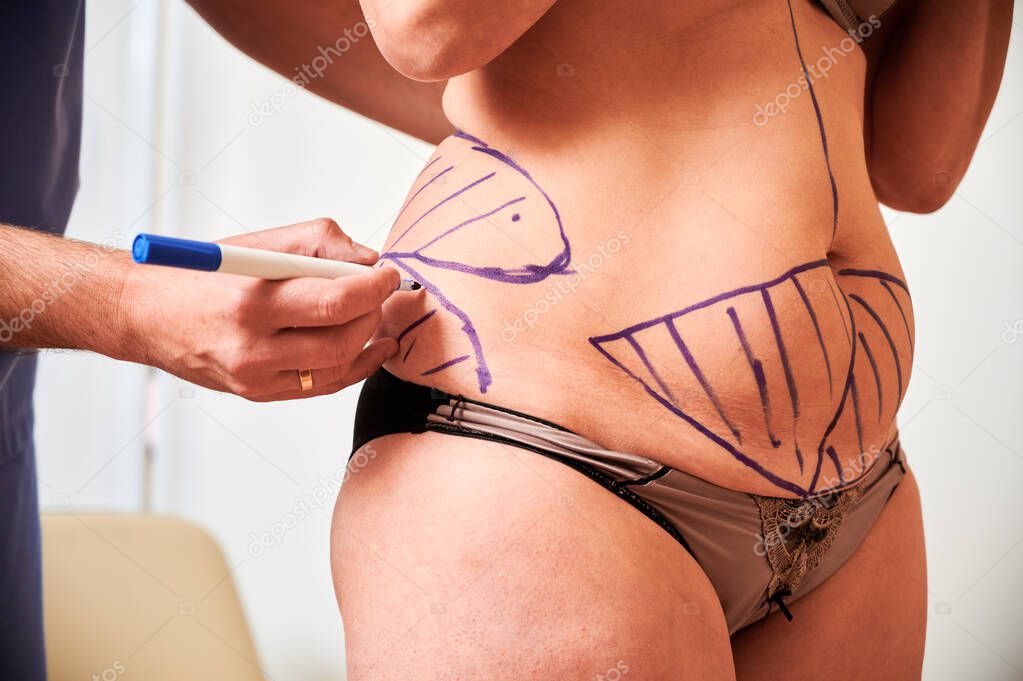 Close up of doctor's hand drawing marks on patient skin of fat woman in underwear before plastic surgery. Concept of plastics, overweight and preparation for aesthetic surgery.