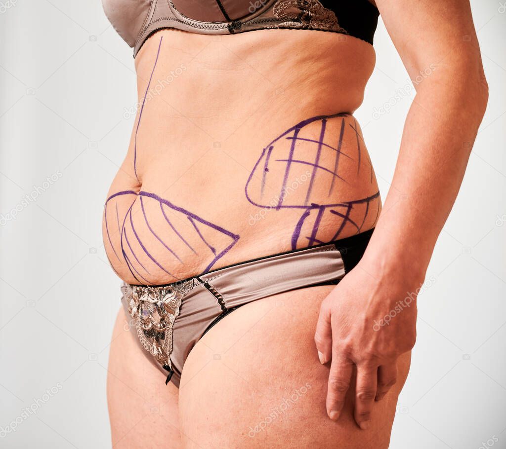 Close up of patient belly with marks for aesthetic surgery. Fat woman in underwear demonstrating results of preoperative marking procedure. Concept of overweight and preparation for plastic surgery.