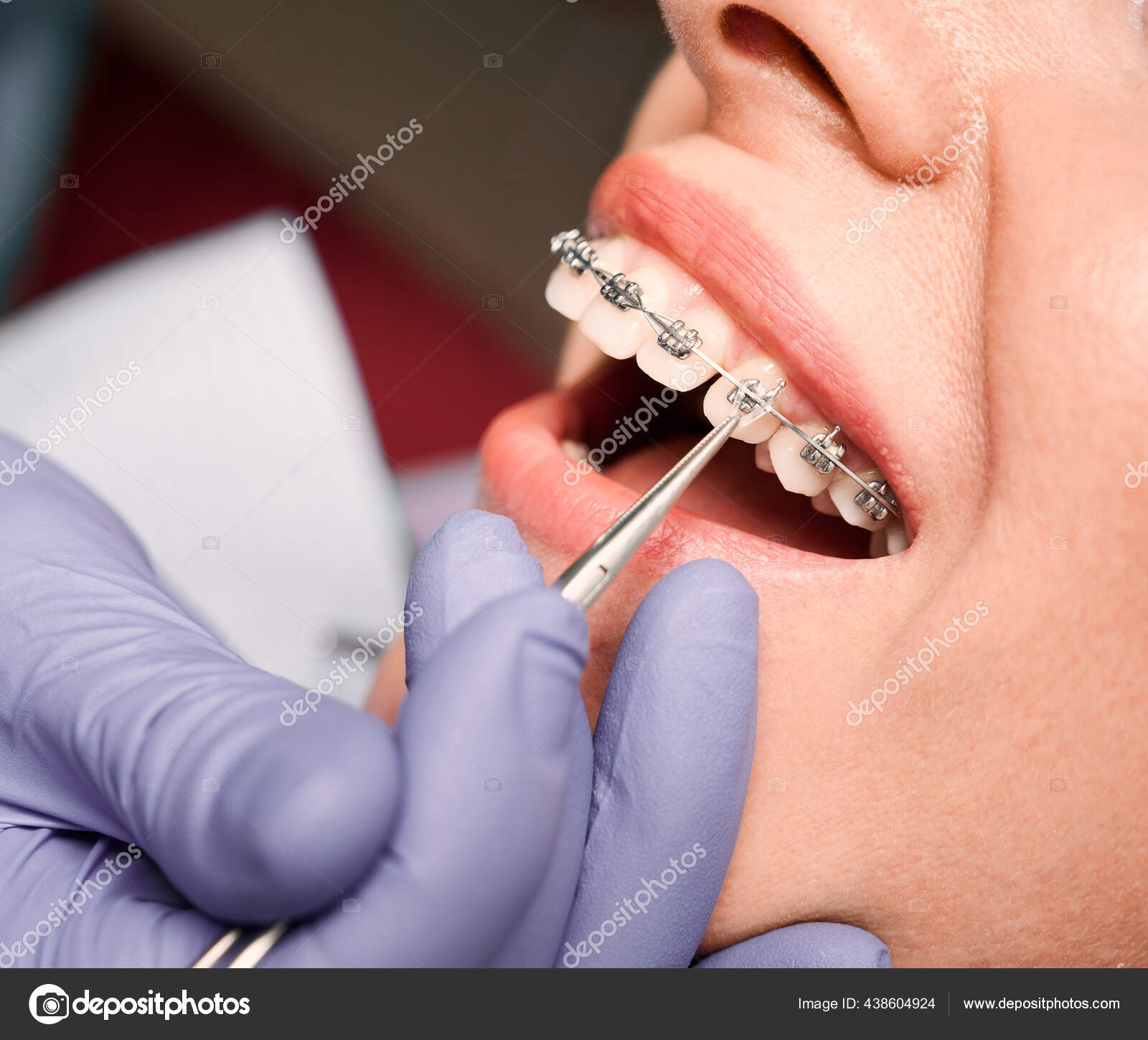 牙科医生手拿着系列手套把弹性橡皮筋贴在病人的支架上在牙科诊所接受正畸治疗的牙齿上有金属丝支撑的妇女