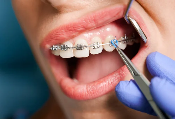 Nahaufnahme Einer Frau Mit Klammern Die Einer Klinik Mit Zahnspangen — Stockfoto