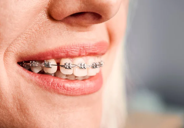 Zbliżenie Pacjentki Uroczym Uśmiechem Demonstrującym Białe Zęby Nawiasami Ortodontycznymi Kobieta — Zdjęcie stockowe