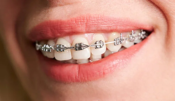 Close Female Patient Showing White Straight Teeth Orthodontic Brackets Woman — Stock Photo, Image