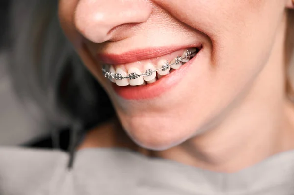 Close Young Woman Charming Smile Demonstrating White Teeth Orthodontic Brackets — Stock Photo, Image