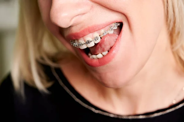 Close Van Lachende Vrouw Likken Witte Rechte Tanden Met Orthodontische — Stockfoto