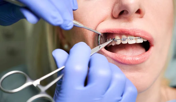 Close up of dentist hands in sterile gloves using dental mirror and forceps while putting orthodontic braces on patient teeth. Woman with braces on teeth having dental procedure in clinic.