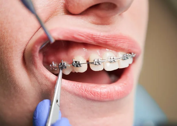 Close up of woman with brackets on white teeth receiving dental braces treatment in clinic. Orthodontist putting orthodontic braces on female patient teeth. Concept of dentistry and stomatology.