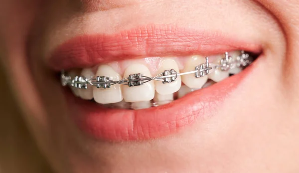 Close Female Patient Showing White Straight Teeth Orthodontic Brackets Woman Stock Photo