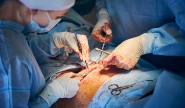 Steril eldivenli doktor ve asistanların estetik ameliyattan sonra dikiş atmalarını kapatın. Ameliyathanede karın estetiği ameliyatı yapan tıp çalışanları. Abdominoplasti kavramı